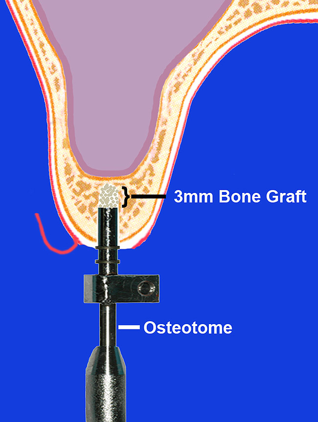 Bone-Added Osteotome Sinus Floor Elevation for the Deficient Maxillary ...