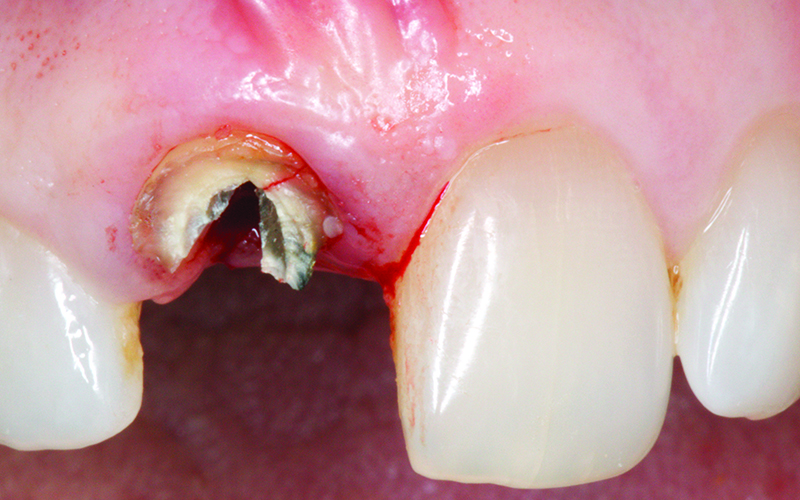 Simplified Fabrication of an Esthetic Implant-Supported Crown With a ...