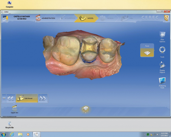 Conservative Preparation Guidelines for CAD/CAM Restorations | Compendium