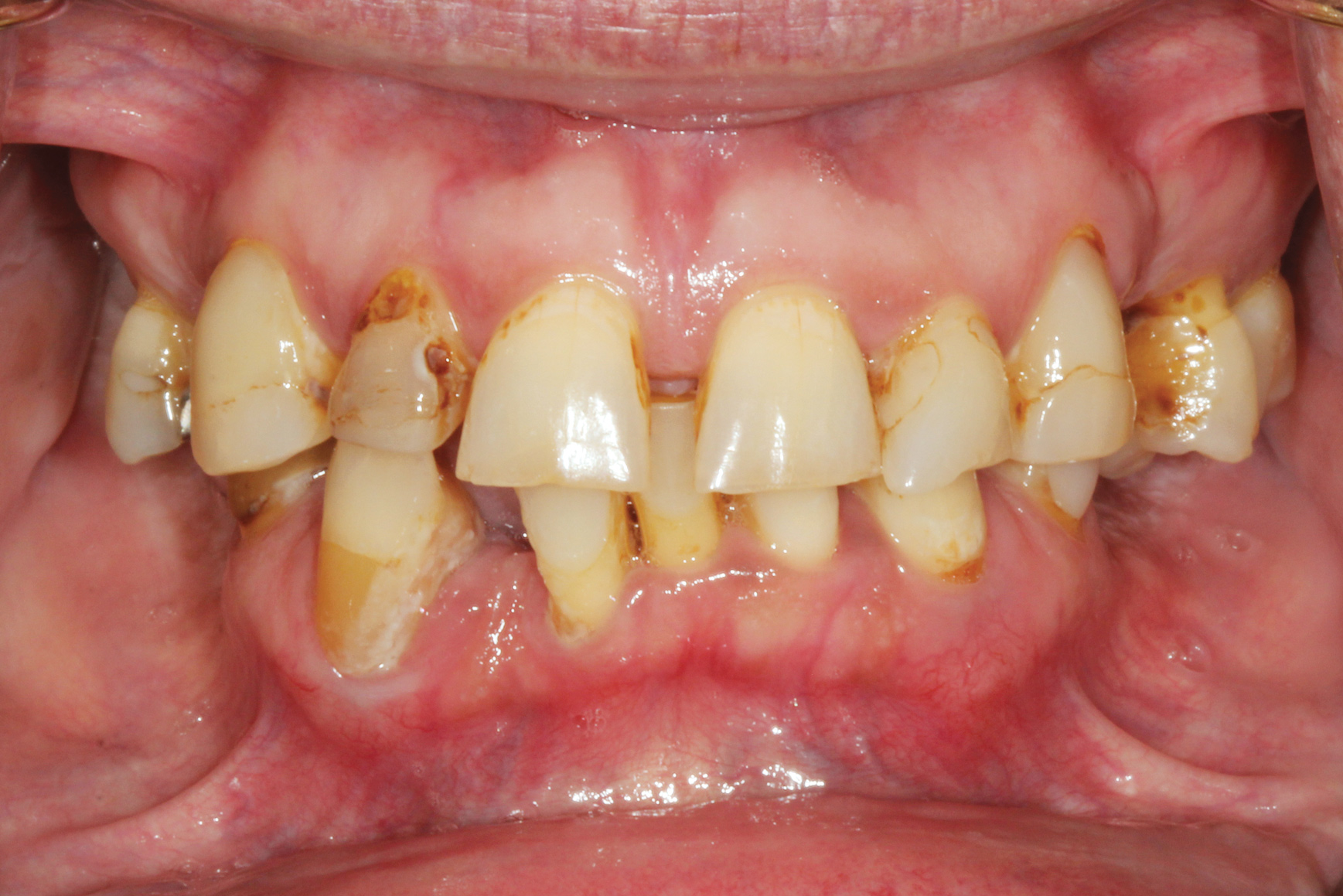 A Minimally Invasive Implant-Supported Fixed Bridge Using a Screwless ...